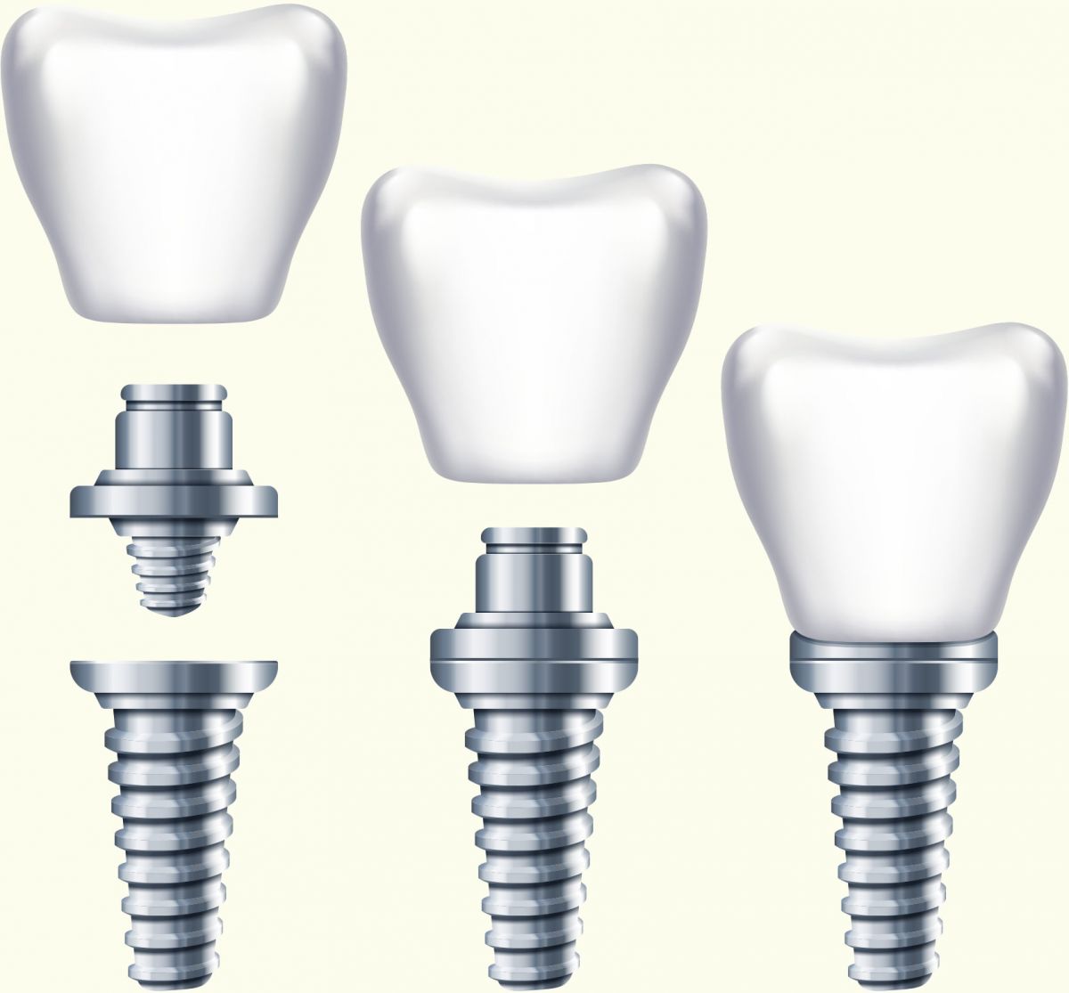 Photo du traitement Les implants et les reconstitutions dentaires sur implants