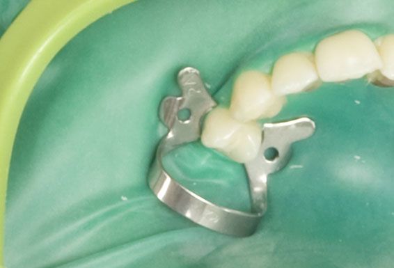 Photo du traitement Le champ opératoire